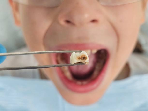 Best Emergency Dental Care for Broken or Chipped Teeth in Rankin, TX